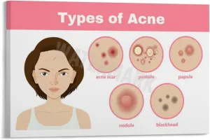 INSTR Beauty Salon Poster Acne Type Guide Art Wall Poster Wall Poster Art Canvas Printing Poster Office Bedroom Aesthetic Poster Frame-style 30x20inch(75x50cm)