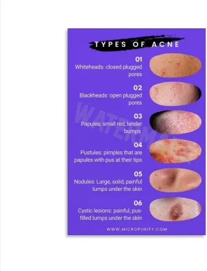 INSTR Beauty Salon Poster Acne Type Guide Art Wall Poster2 Home Living Room Bedroom Decoration Gift Printing Art Poster Unframe-style 24x36inch(60x90cm)
