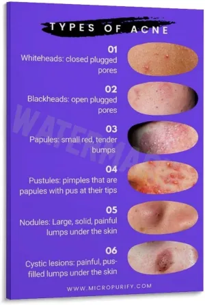 INSTR Beauty Salon Poster Acne Type Guide Art Wall Poster2 Wall Poster Art Canvas Printing Poster Office Bedroom Aesthetic Poster Frame-style 20x30inch(50x75cm)