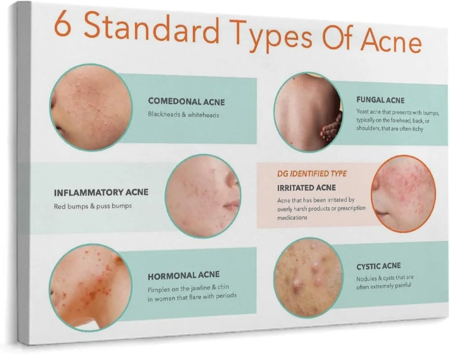 Types of Acne Poster Medical Beauty Poster (4) Wall Poster Art Canvas Printing Living Room Office Bedroom Aesthetic Poster 32x24inch(80x60cm) Frame-style