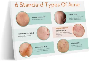 Types of Acne Poster Medical Beauty Poster (4) Wall Poster Art Canvas Printing Living Room Office Bedroom Aesthetic Poster 32x24inch(80x60cm) Frame-style