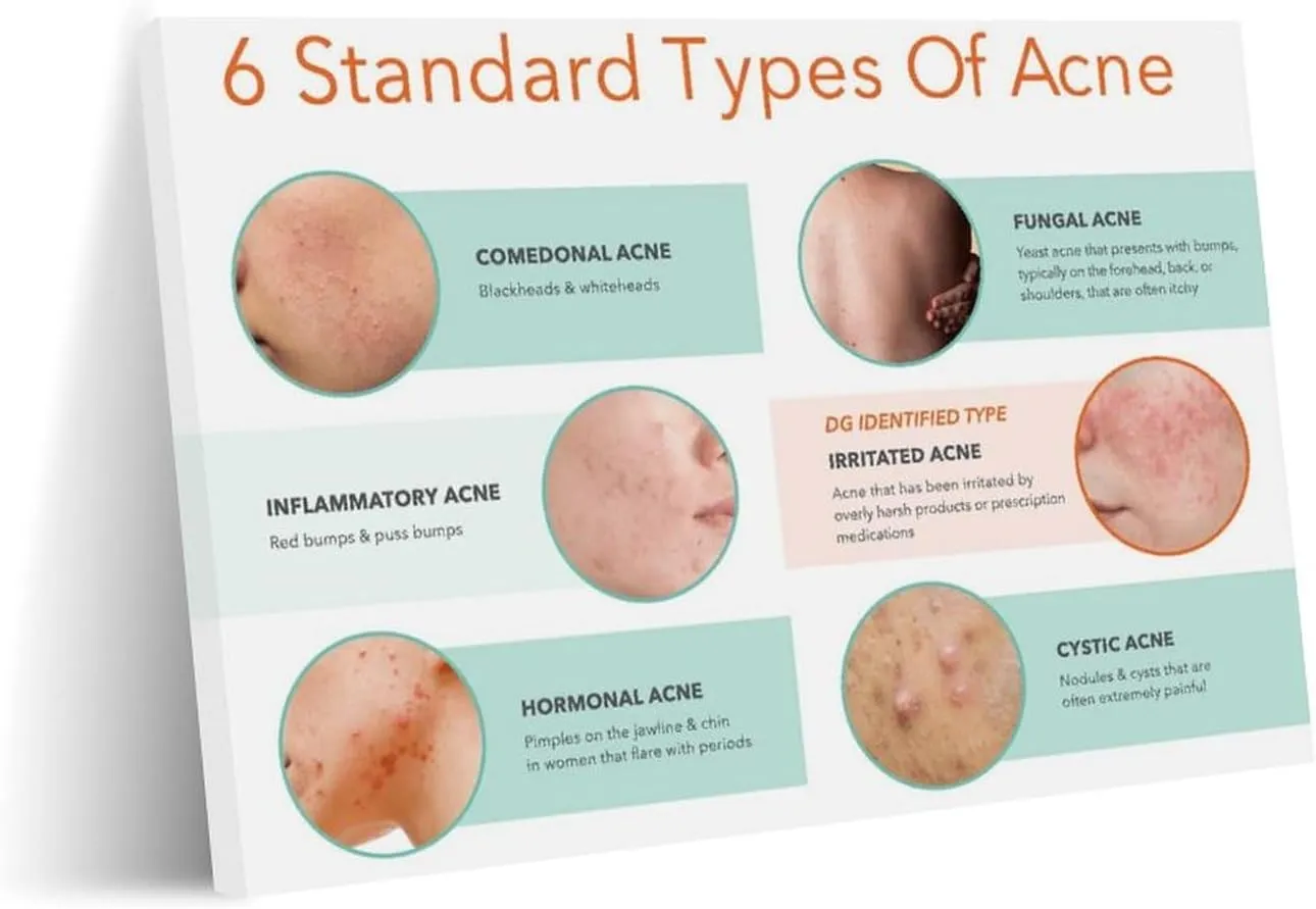 Types of Acne Poster Medical Beauty Poster (4) Wall Poster Art Canvas Printing Living Room Office Bedroom Aesthetic Poster 32x24inch(80x60cm) Frame-style